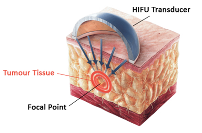 HIFU_Treatment.png