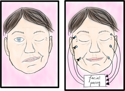 Figure 2. Facial Pacing Principle